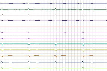 s0301lre-patient155 thumbnail