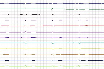 s0303lre-patient105 thumbnail