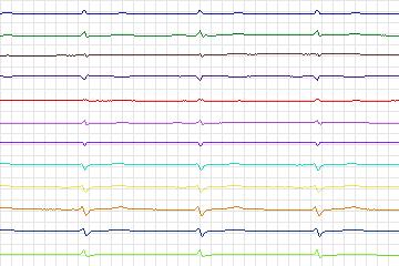 s0304lre-patient172 thumbnail