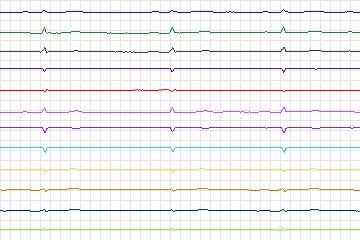 s0305lre-patient173 thumbnail