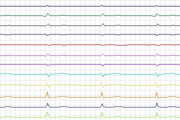 s0306lre-patient104 thumbnail