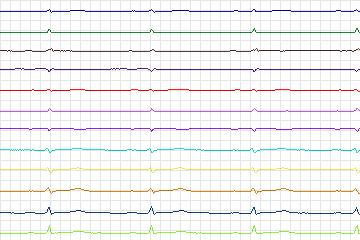 s0308lre-patient182 thumbnail