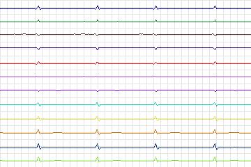 s0311lre-patient121 thumbnail