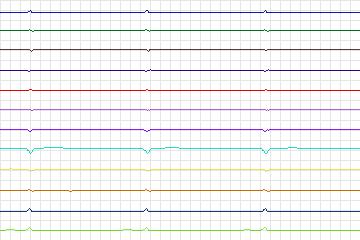 Electrocardiogram for PTB Diagnostic ECG, record s0313lre-patient084