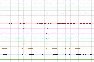 Electrocardiogram for PTB Diagnostic ECG, record s0314lre-patient049