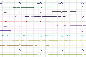 Electrocardiogram for PTB Diagnostic ECG, record s0315lre-patient080