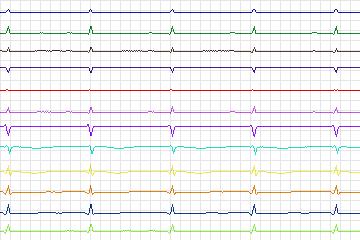 Electrocardiogram for PTB Diagnostic ECG, record s0316lre-patient086