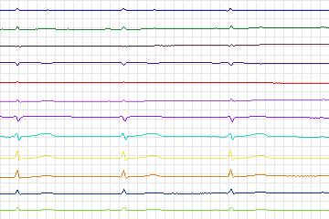 s0318lre-patient072 thumbnail