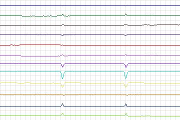 Electrocardiogram for PTB Diagnostic ECG, record s0320lre-patient082