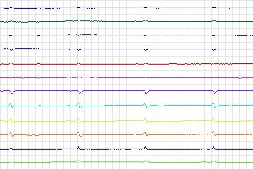 Electrocardiogram for PTB Diagnostic ECG, record s0321lre-patient087