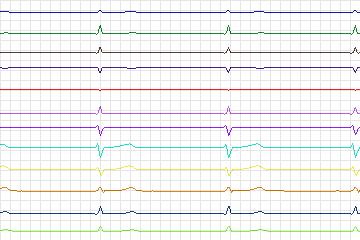 s0323lre-patient165 thumbnail