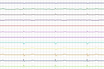 s0324lre-patient174 thumbnail