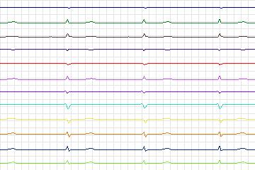 s0325lre-patient174 thumbnail