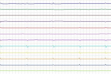 s0326lre-patient087 thumbnail