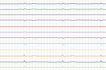 s0328lre-patient169 thumbnail