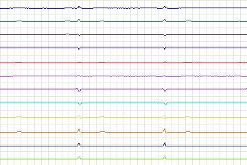 s0329lre-patient169 thumbnail