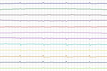 s0330lre-patient087 thumbnail