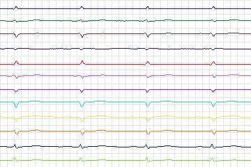 s0331lre-patient120 thumbnail