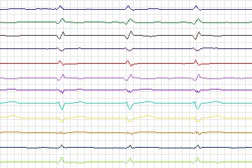 s0334lre-patient135 thumbnail