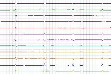 s0339lre-patient088 thumbnail