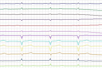 s0342lre-patient127 thumbnail