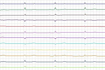 s0345lre-patient085 thumbnail