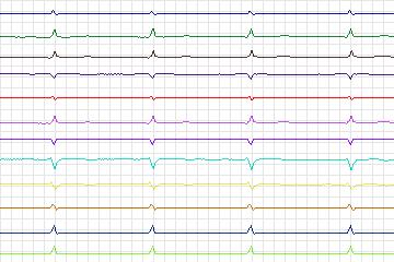 Electrocardiogram for PTB Diagnostic ECG, record s0346lre-patient081