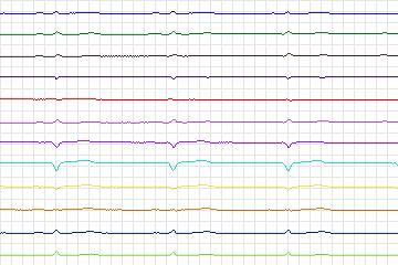 Electrocardiogram for PTB Diagnostic ECG, record s0347lre-patient042