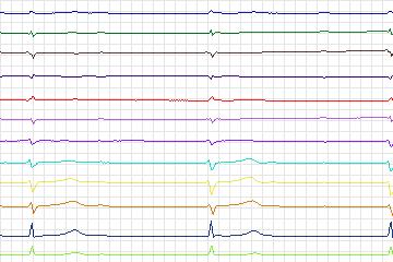 s0349lre-patient109 thumbnail