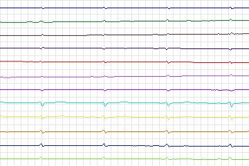 s0354lre-patient092 thumbnail