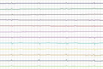 s0358lre-patient092 thumbnail