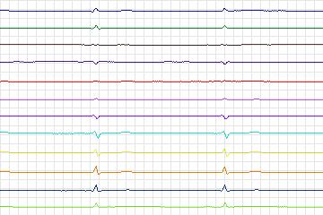 s0360lre-patient090 thumbnail