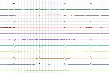 s0363lre-patient184 thumbnail