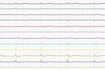 s0364lre-patient171 thumbnail