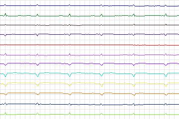 s0370lre-patient094 thumbnail