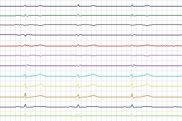 s0378lre-patient093 thumbnail