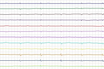 s0386lre-patient098 thumbnail