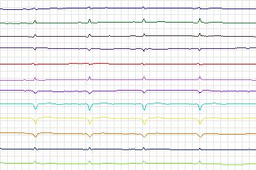 s0387lre-patient099 thumbnail