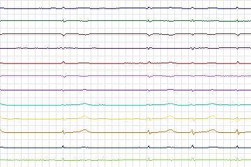 s0389lre-patient098 thumbnail