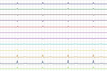 s0390lre-patient159 thumbnail