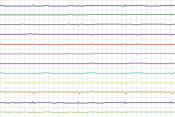 s0398lre-patient098 thumbnail