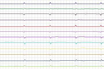 s0401lre-patient100 thumbnail