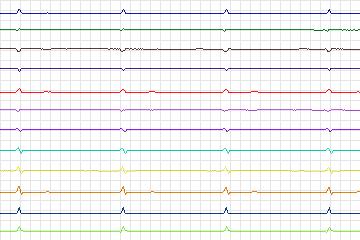 Electrocardiogram for PTB Diagnostic ECG, record s0406lre-patient074