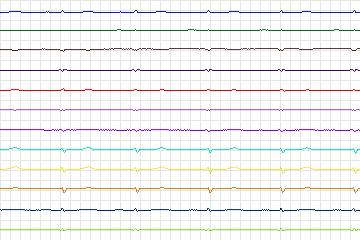 s0409lre-patient098 thumbnail