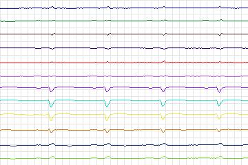 s0414lre-patient101 thumbnail