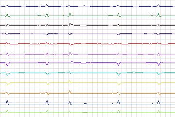 s0416lre-patient102 thumbnail