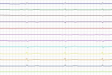 s0418lre-patient090 thumbnail