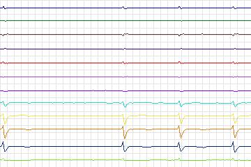 Electrocardiogram for PTB Diagnostic ECG, record s0420_re-patient201