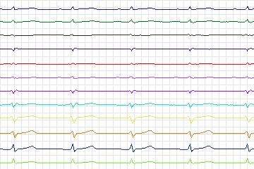 Electrocardiogram for PTB Diagnostic ECG, record s0421_re-patient202