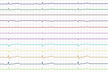 Electrocardiogram for PTB Diagnostic ECG, record s0422_re-patient202